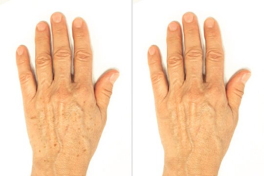 Age spots on the hands before and after removal using a lightening whitening cream. Rejuvenation procedure, laser treatment, peeling. Liver spots, lentigo, sun spots. Cosmetology and beauty concept