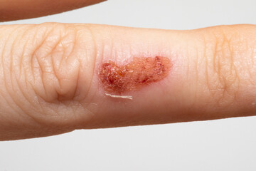 female hand with impetigo, a bacterial infection that causes skin lesions
