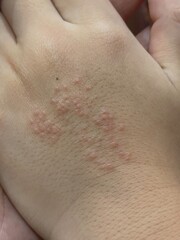 The rash is red and has small, clear blisters. On the skin on the back of the hand is caused by an...