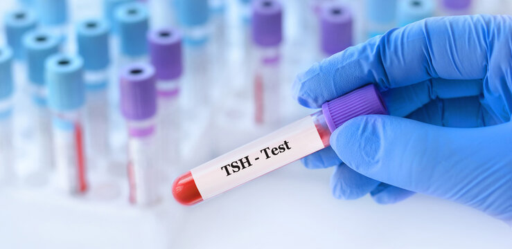 Doctor holding a test blood sample tube with thyroid stimulating hormone (TSH) test on the background of medical test tubes with analyzes