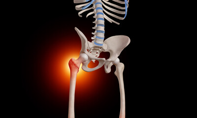 Intertrochanteric fracture on the femur head skeleton 3D medical illustration