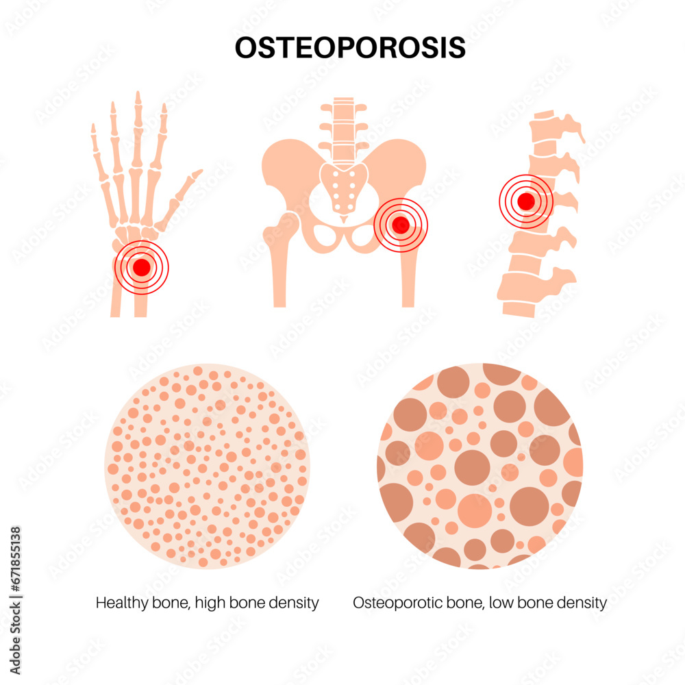 Sticker Osteoporosis medical poster