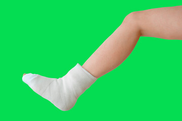 Broken leg on a green background in a plaster cast. Foot bone bruise or fracture. Insurance claim scenario. Injury, trauma, recovery, rehabilitation concept. Talus foot bone fracture