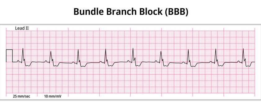 ECG Bundle Branch Block - 8 Second ECG Paper - Electrocardiogram Vector Medical Illustration