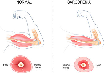 Sarcopenia.  Muscle loss.