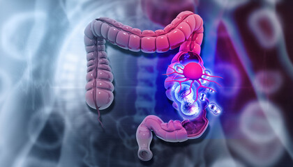Human colon cancer. 3d illustration..