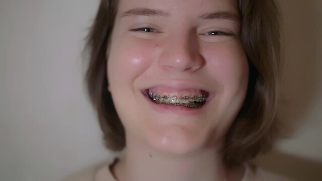 Caucasian positive woman teenager with braces smiling laughing, beauty and dental concept. Happy girl smiling with teeth brackets. Metal self-ligating braces. Orthodontic treatment
