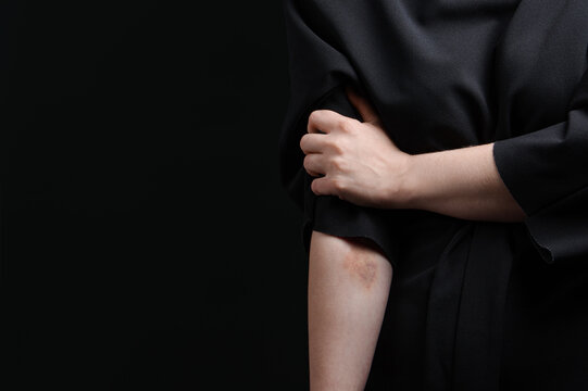 a girl with wounds on her hand on a black background in a black dress.