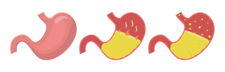 Healthy human stomach, heartburn and gastroesophageal reflux disease vector illustration