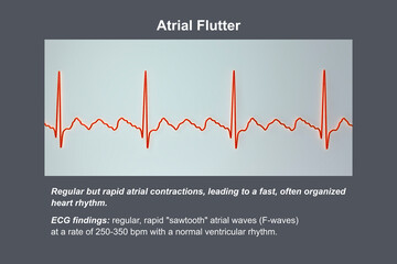 ECG in atrial flutter, an abnormal heart rhythm characterized by rapid, regular contractions of the atria, 3D illustration