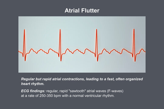 ECG in atrial flutter, an abnormal heart rhythm characterized by rapid, regular contractions of the atria, 3D illustration