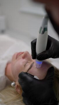 Laser polishing of the skin of the face