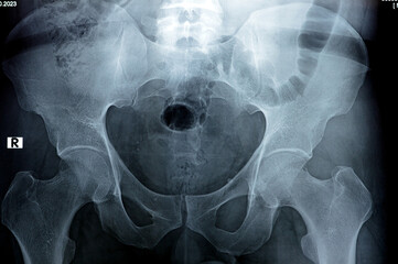 Hip joints digital radiographic examination reveals normal appearance of hip joins, multiple pelvic...