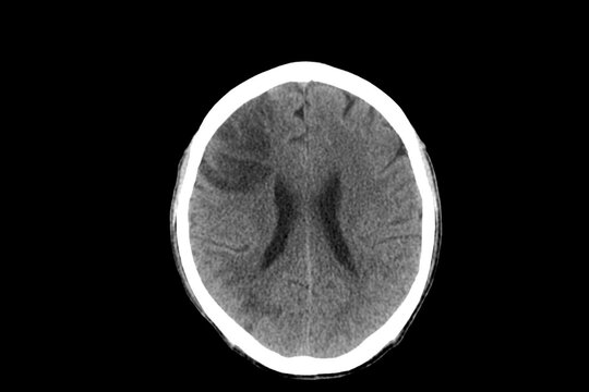 CT scan of human brain imaging on a black background. Xray showed cerebral infarction in hemiparesis patient in hospital.Doctor did medical treatment.Computer tomography scan of brain.Emergency care.