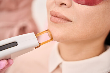 Asian client of cosmetology clinic undergoing chin laser hair removal procedure