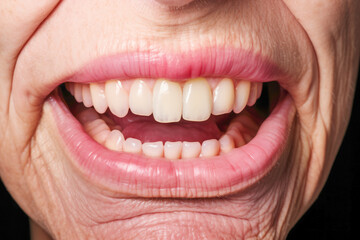 A senior woman with visible wrinkles and unpleasant smell issues related to dental problems, underlining the significance of proper health care and the effects of neglecting it in old age.