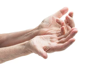 Papier Peint photo Lavable Vielles portes Hands of an old woman with Dupuytren's contracture disease