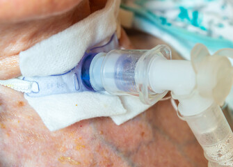 Old age woman with Alzheimer after tracheostomy operation for breathing help in home.