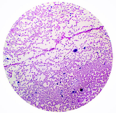 Bacterial colonies gram stained microscopic show Staphylococcus aureus  Bacteria.