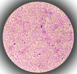 Bacterial colonies gram stained microscopic show Staphylococcus aureus  Bacteria.