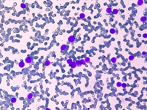 Acute myeloid leukemia (AML) is a type of blood cancer. Microscopic 10x examination of blasts or leukemia cells in blood smear of human.