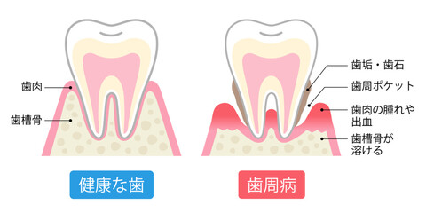 歯周病と健康な歯　比較　断面図