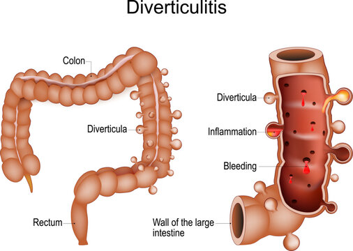Colonic Diverticulitis.