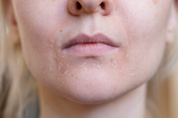The woman skin flakes off at the mouth. Dry skin. Face skin irritation after peeling, after cold...