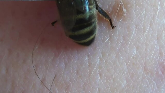 Apitherapy. With the help of tweezers, the bee is placed on the skin of a person and deliberately forced to sting. Bee stings for health and healing. Treatment of arthritis with bee venom