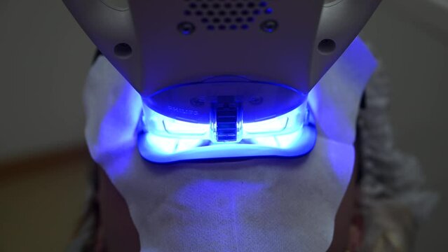 Dental Whitening process in patient mouth. Teeth whitening with UF Lamp, Led Lamp and gel. Dental Extreme Close up Macro Video. Concept of professional dental hygiene. 4k 120 fps slow motion footage