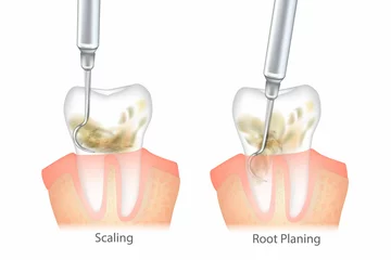 Fotobehang Difference of the Periodontal Scaling and Root Planing. Oral hygiene and conventional periodontal therapy. Human teeth cleaning treatment. Dental scale. © sakurra