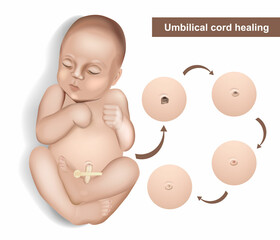 Umbilical cord care in newborns. Newborn umbilical cord stump falling off cycle. Dried stump of an umbilical cord of a newborn baby. Healing