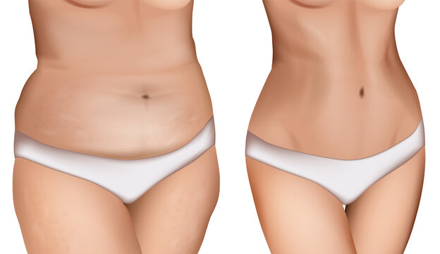 Vector illustration of fat and slim female body. Cellulite problem. Before and after weight loss.