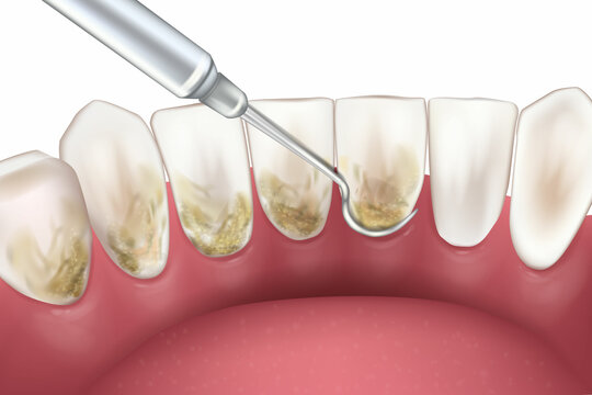 Periodontal Scaling and Root Planing. Oral hygiene and conventional periodontal therapy. Medically accurate of human teeth cleaning treatment.