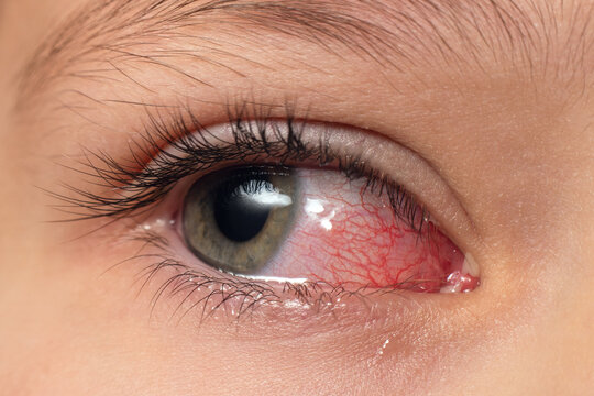 Closeup irritated infected red bloodshot eyes, conjunctivitis