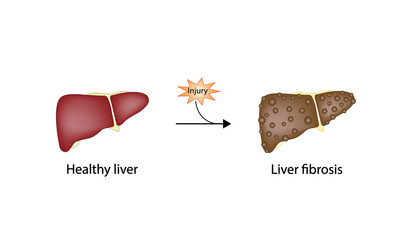 Liver fibrosis. Liver injury. Hepatic stellate cell, HSC. Vector illustration. - obrazy, fototapety, plakaty