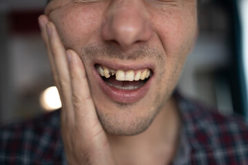 Man with extracted tooth after tooth removal surgery. Pain after tooth extraction - obrazy, fototapety, plakaty