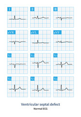 When a small ventricular septal defect has little or even no impact on hemodynamics, the patient's electrocardiogram can be completely or roughly normal.