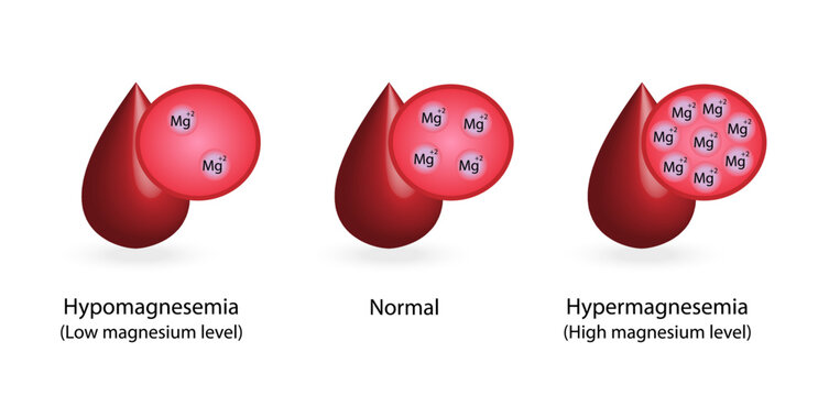 Hypermagnesemia, high plasma magnesium level and hypomagnesemia, low plasma magnesium level. magnesium Mg excess and deficit electrolyte disorders, blood test tube, Scientific vector illustration.