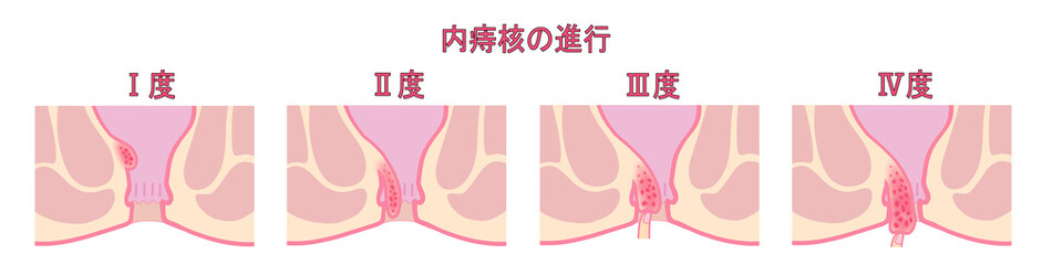 Obraz premium 内痔核の進行度による分類のイラスト