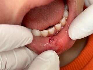 Befund nach Zahnunfall