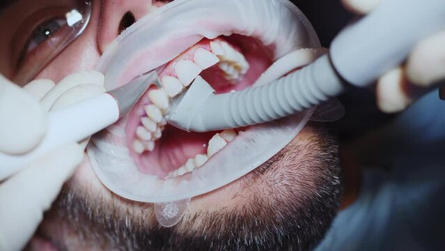 A dentist cleans a man's teeth. Hydience and healthy in modern clinic. Healthcare