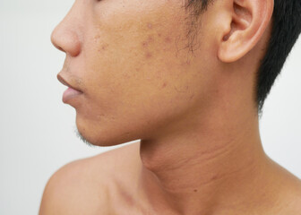 Close-up of Asian man's face with skin problems and acne scars