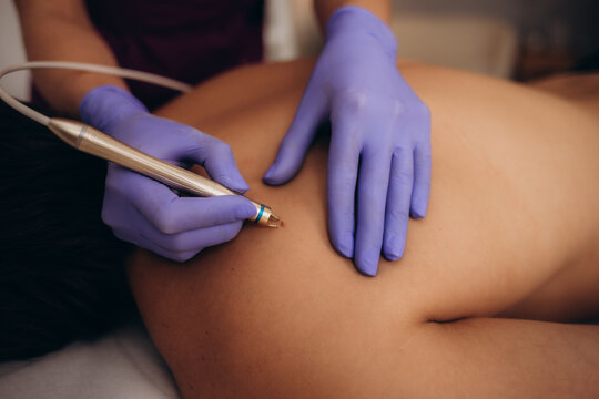 A beautician removes papillomas on a man's back