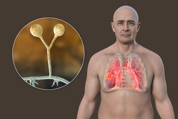 A man with lung mucormycosis lesion, with close-up view of Rhizomucor fungi, 3D illustration