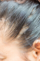 Dandruff, flaky scalp caused by dry skin. Allergy to cosmetics or has fungus