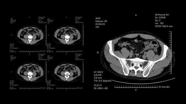 CT scan. MRI x ray Scan.Medical HUD Analyzing abdominal appendicitis diagnosis. Technological Interface. Healthcare. 2D generated