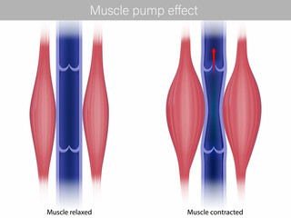 Skeletal Muscle pump effect. Illustration of muscle pump effect on venous return and muscle blood. Calf Muscles contracted and relaxed - obrazy, fototapety, plakaty