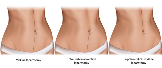 Abdominal midline incision. Incision sites of midline laparotomies. Midline laparotomy, Infraumbilical and Supraumbilical midline laparotomy. - obrazy, fototapety, plakaty