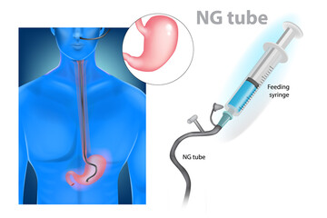 Nasogastric intubation  (nasogastric tube or NG tube) - obrazy, fototapety, plakaty